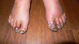 Congelaciones en los pies de Lolo